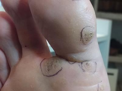 Verruca Pedis